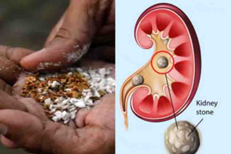  kidney stones due to Pan masala
