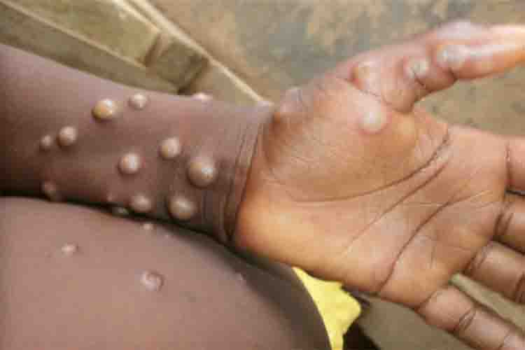 Pakistan confirms first case of monkeypox in 2024, victim had returned from Saudi