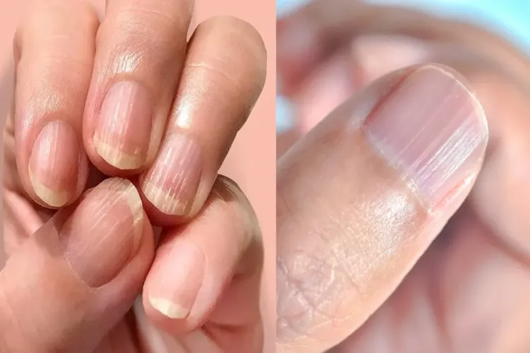 WHO) has recently issued a health warning saying that lines appearing on the nails are not just a cosmetic problem