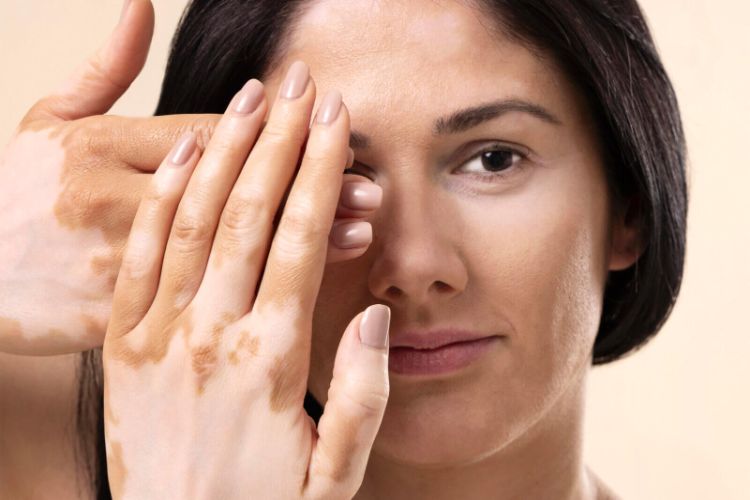 Mimiq launched in India, redefining beauty for vitiligo