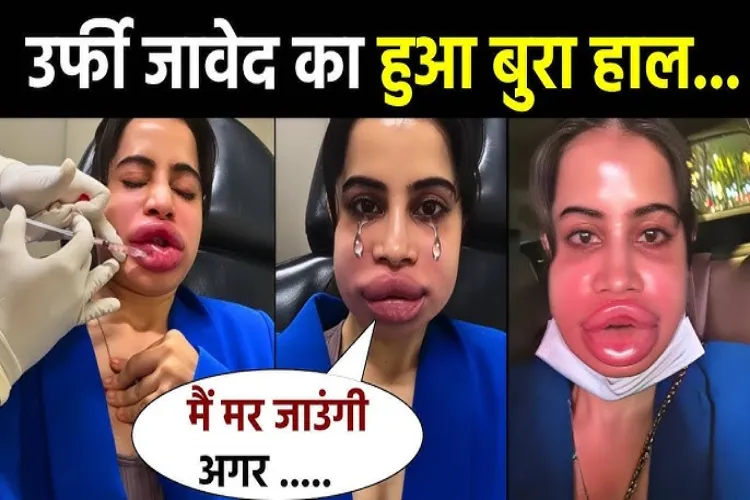 Urfi Javed got her lip fillers removed: Know the advantages, disadvantages and cost of getting lip fillers