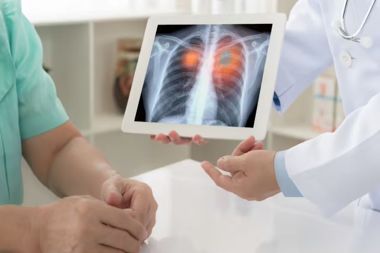 World Lung Cancer day: Now it is not just a smokers' disease, WHO made a shocking revelation