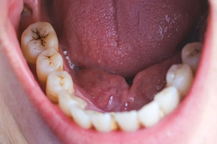 Tooth decay increases the risk of oral cancer, take care of your oral health like this