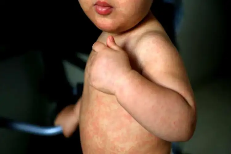 UN agency PAHO warns of sharp measles surge across Americas, urges action