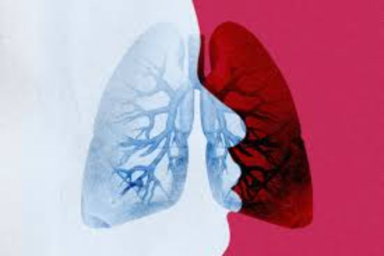 40% of lung cancer patients never smoked, government should establish national screening program