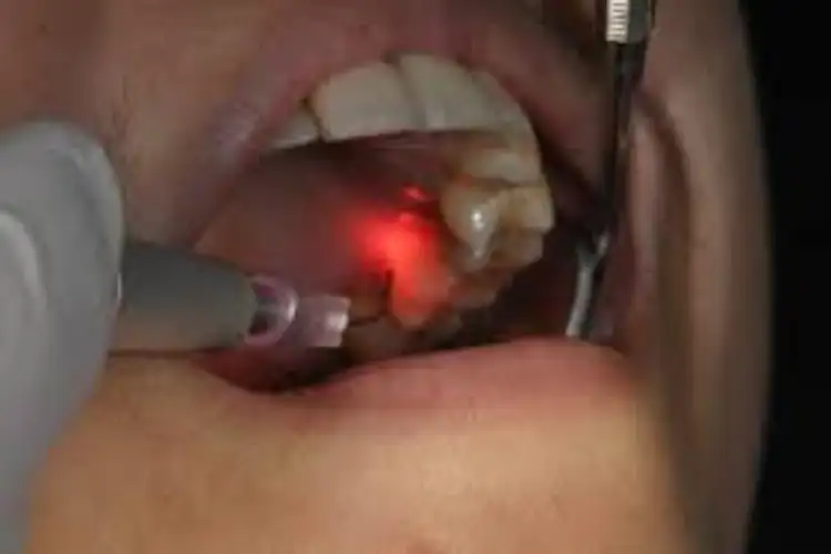 Laser to the rescue: Delhi doctors vaporise stuck denture to save patient from major surgery