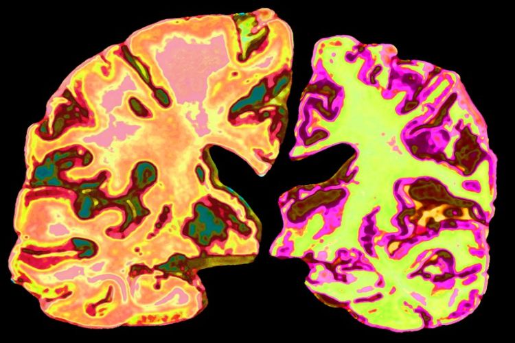 New hope for Alzheimer's treatment