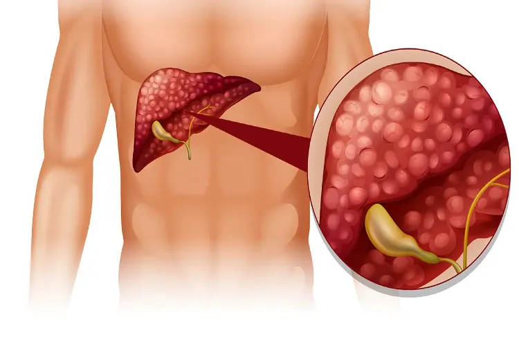 Can fatty liver be cured without medication?